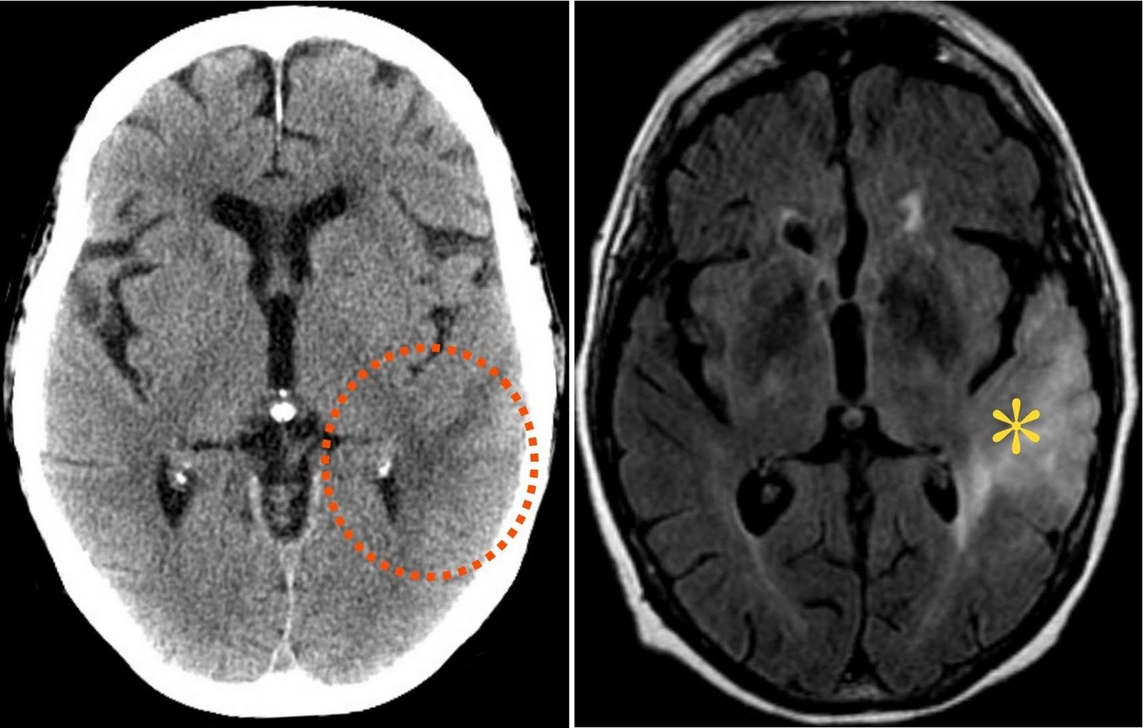 Различия визуализации опухоли головного мозга на МРТ и КТ